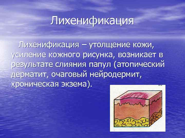Лихенификация – утолщение кожи, усиление кожного рисунка, возникает в результате слияния папул (атопический дерматит,