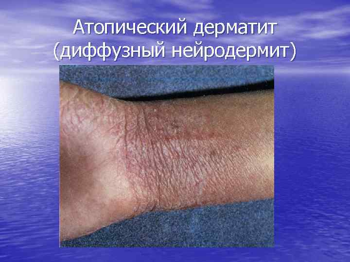 Атопический дерматит (диффузный нейродермит) 