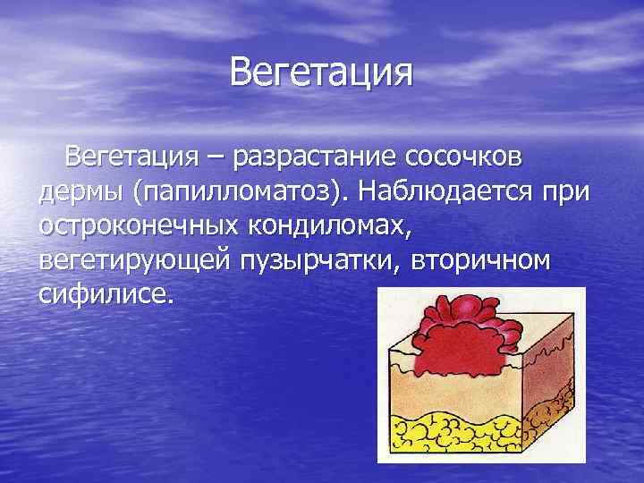 Вегетация – разрастание сосочков дермы (папилломатоз). Наблюдается при остроконечных кондиломах, вегетирующей пузырчатки, вторичном сифилисе.