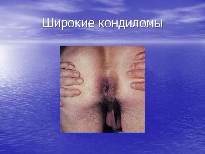 Широкие кондиломы 