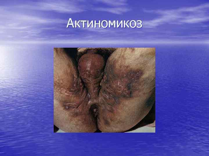 Актиномикоз 