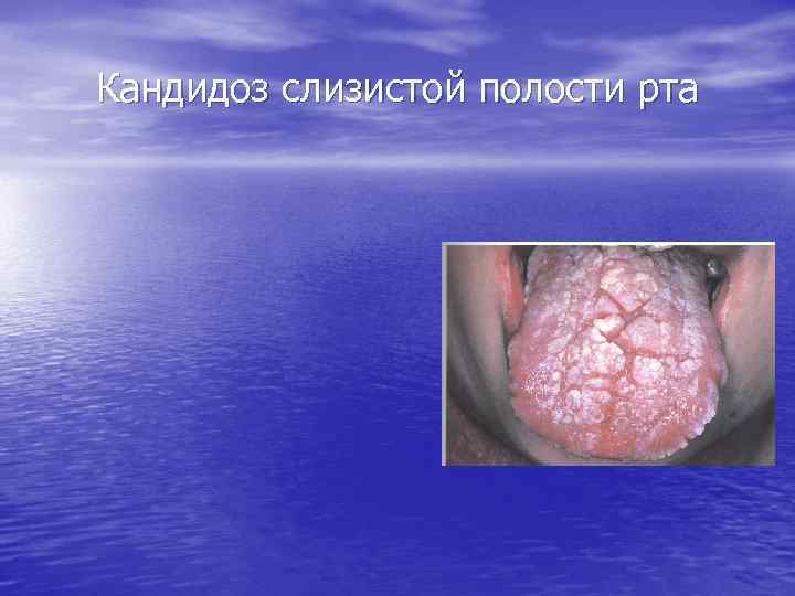 Кандидоз слизистой полости рта 