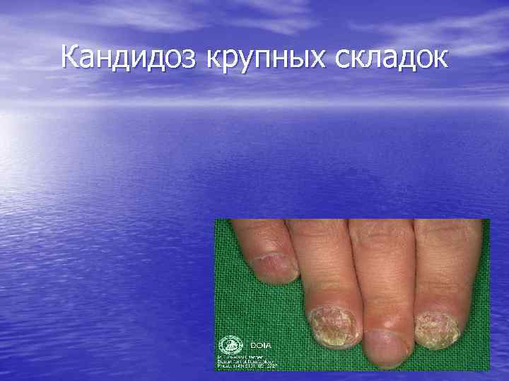 Кандидоз крупных складок 