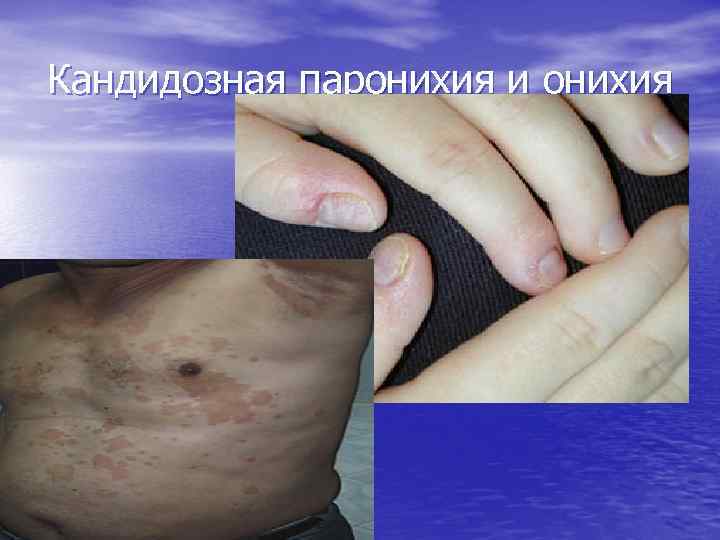 Кандидозная паронихия и онихия 