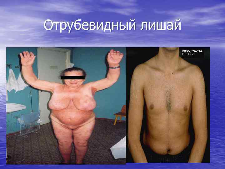 Отрубевидный лишай 