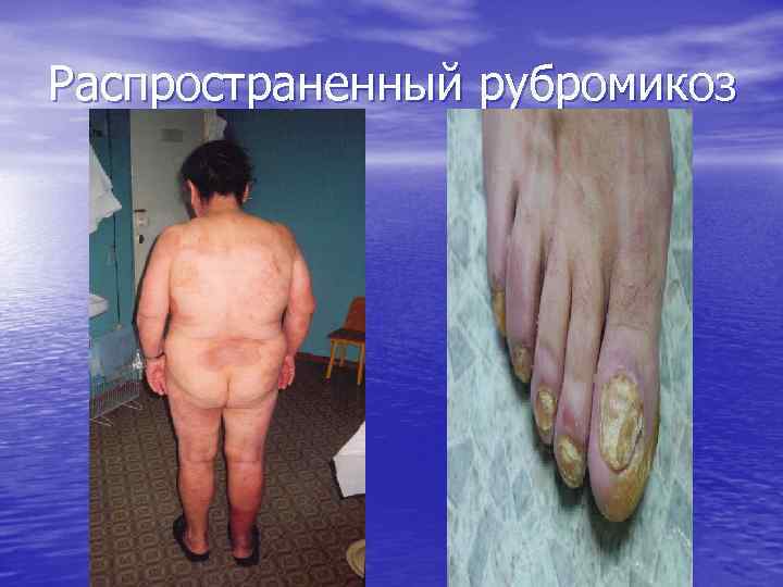 Распространенный рубромикоз 