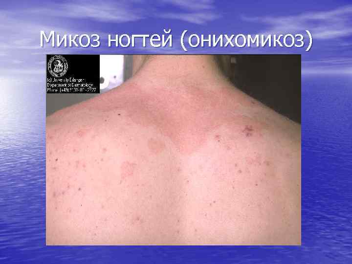 Микоз ногтей (онихомикоз) 