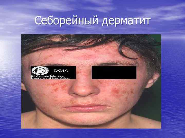 Себорейный дерматит 