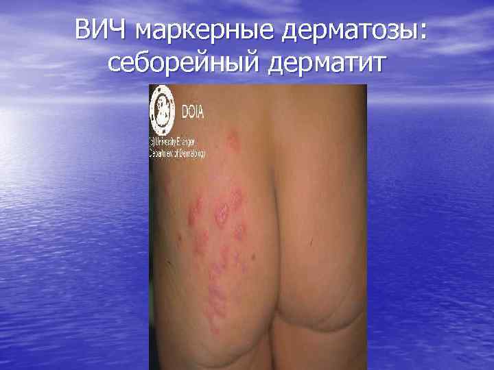 ВИЧ маркерные дерматозы: себорейный дерматит 