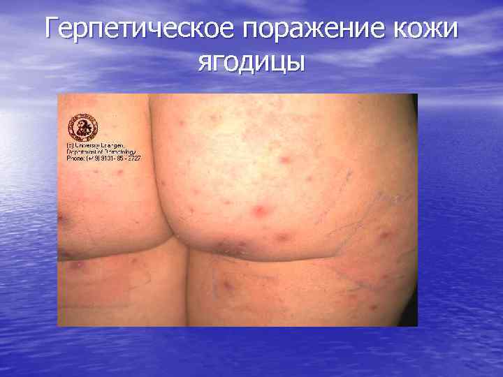 Герпетическое поражение кожи ягодицы 
