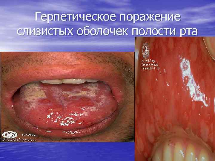 Герпетическое поражение слизистых оболочек полости рта 