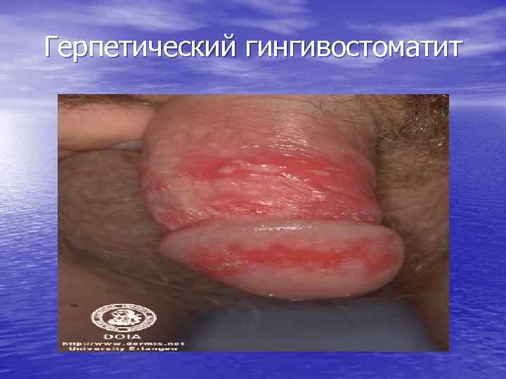 Герпетический гингивостоматит 