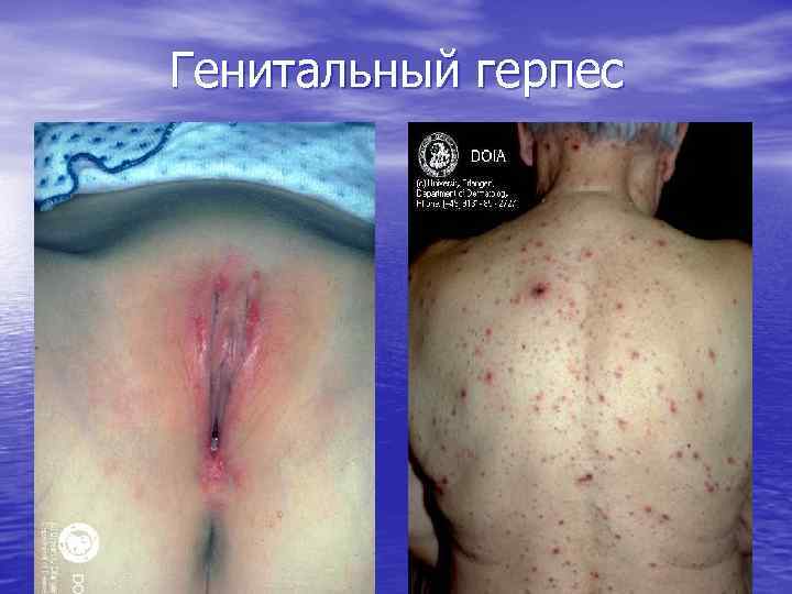 Генитальный герпес 