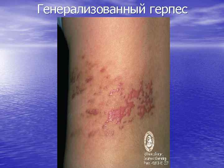 Генерализованный герпес 
