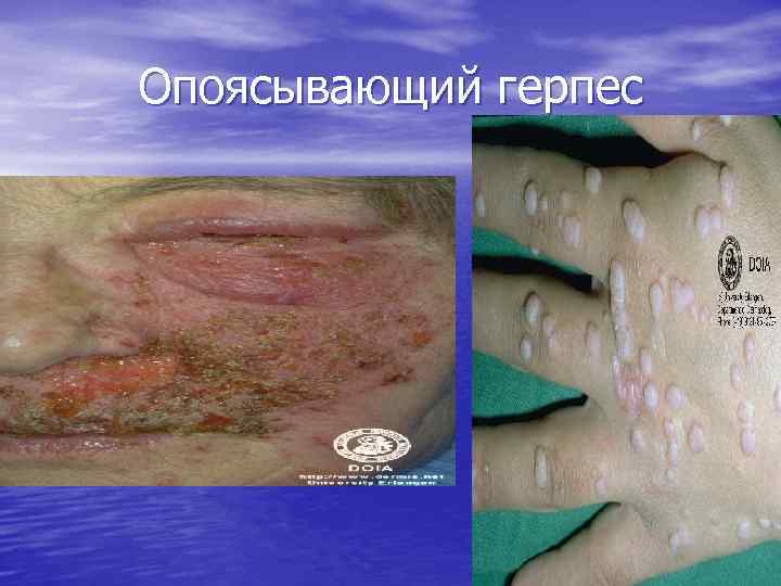 Опоясывающий герпес 