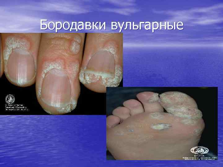 Бородавки вульгарные 