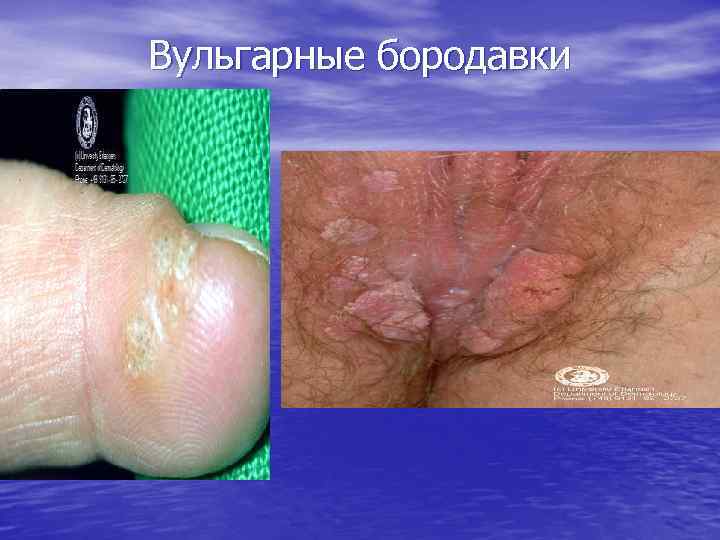 Вульгарные бородавки 