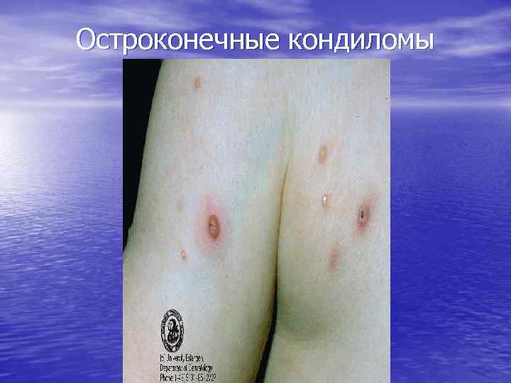 Остроконечные кондиломы 