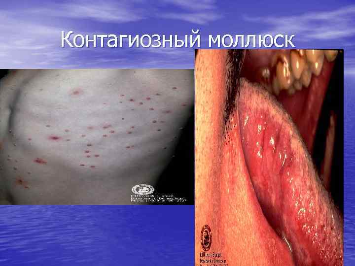 Контагиозный моллюск 