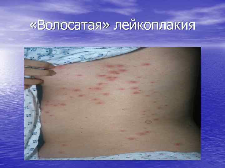  «Волосатая» лейкоплакия 