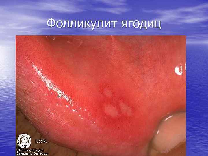 Фолликулит ягодиц 