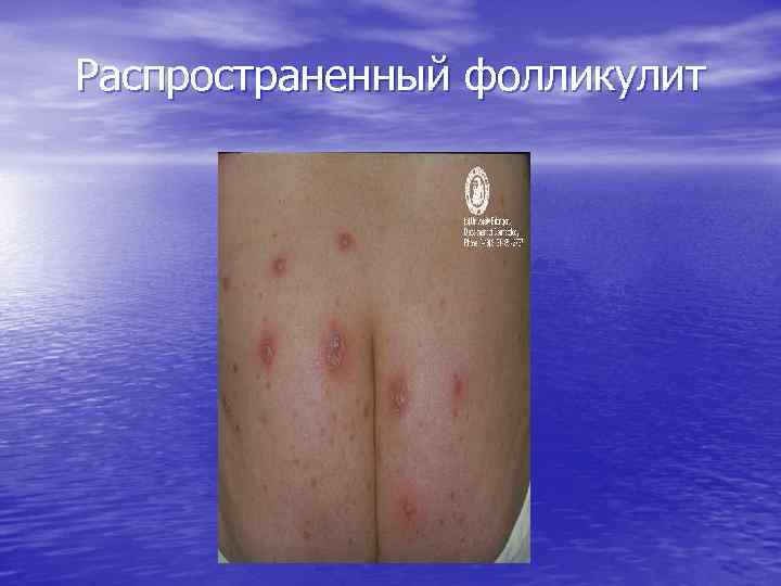 Распространенный фолликулит 