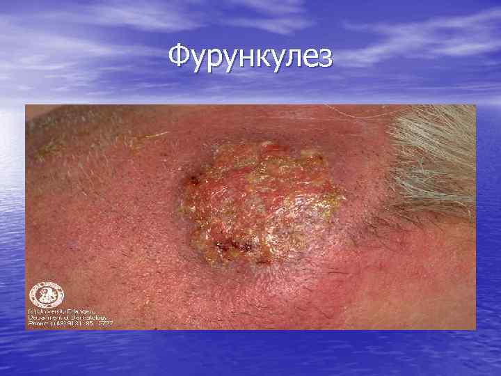 Фурункулез 