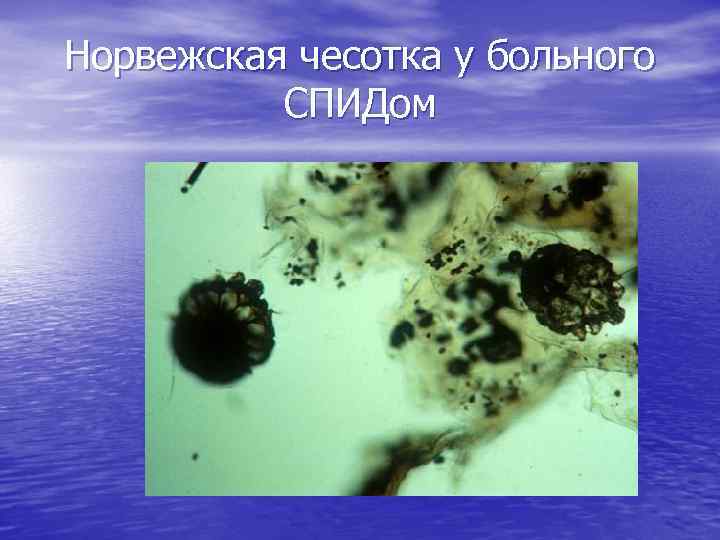 Норвежская чесотка у больного СПИДом 