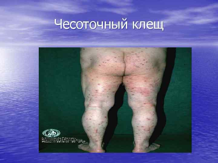 Чесоточный клещ 