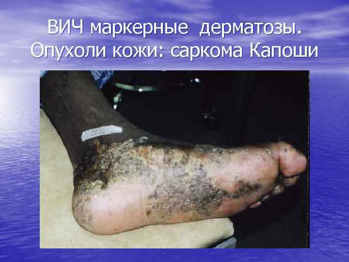 ВИЧ маркерные дерматозы. Опухоли кожи: саркома Капоши 