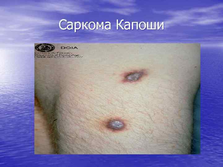 Саркома Капоши 