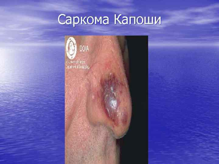 Саркома Капоши 