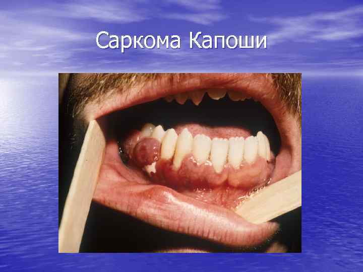 Саркома Капоши 