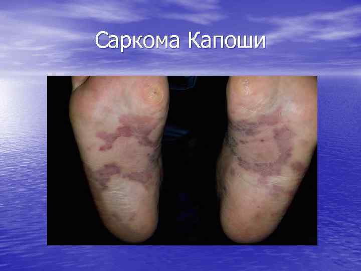 Саркома Капоши 