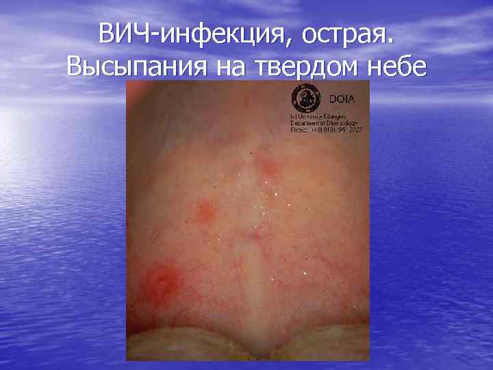 ВИЧ-инфекция, острая. Высыпания на твердом небе 