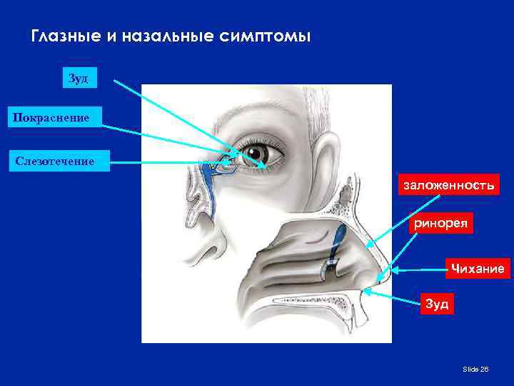 Глазные и назальные симптомы Зуд Покраснение Слезотечение заложенность ринорея Чихание Зуд Slide 26 