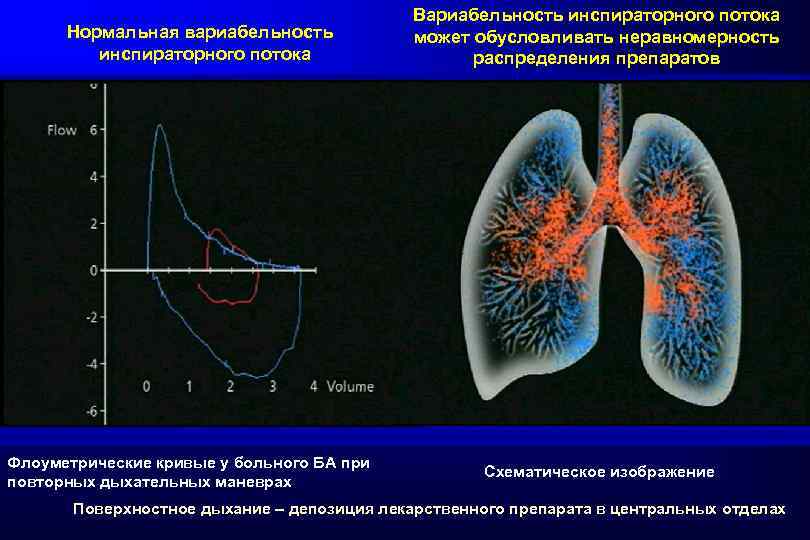 Нормальная вариабельность инспираторного потока Флоуметрические кривые у больного БА при повторных дыхательных маневрах Вариабельность