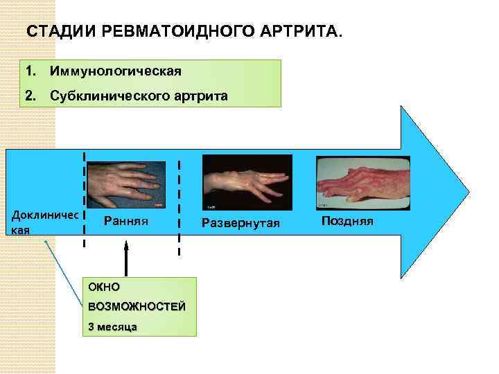 СТАДИИ РЕВМАТОИДНОГО АРТРИТА. 1. Иммунологическая 2. Субклинического артрита Доклиничес кая Ранняя ОКНО ВОЗМОЖНОСТЕЙ 3