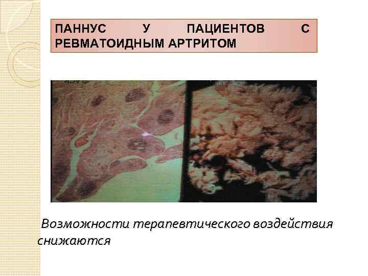 ПАННУС У ПАЦИЕНТОВ РЕВМАТОИДНЫМ АРТРИТОМ С Возможности терапевтического воздействия снижаются 