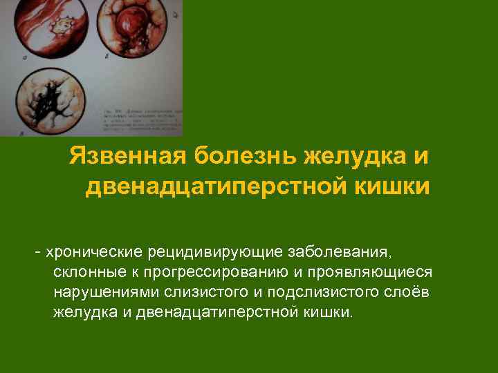 Язвенная болезнь желудка и двенадцатиперстной кишки - хронические рецидивирующие заболевания, склонные к прогрессированию и