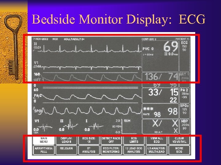 Bedside Monitor Display: ECG 