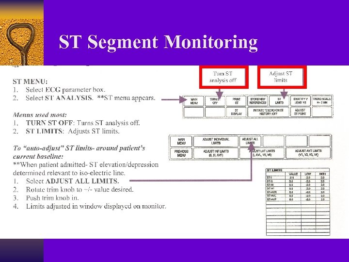 ST Segment Monitoring 