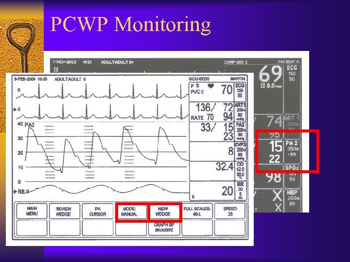 PCWP Monitoring 