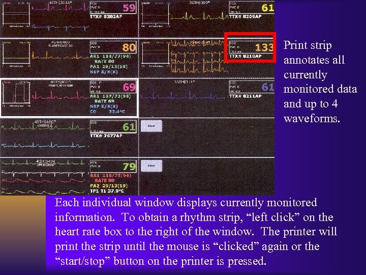 Print strip annotates all currently monitored data and up to 4 waveforms. Each individual