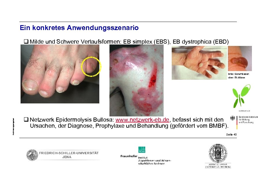 Ein konkretes Anwendungsszenario Archivierungsangaben q Milde und Schwere Verlaufsformen: EB simplex (EBS), EB dystrophica