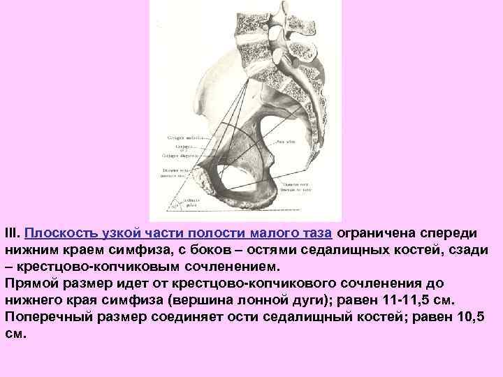 III. Плоскость узкой части полости малого таза ограничена спереди нижним краем симфиза, с боков