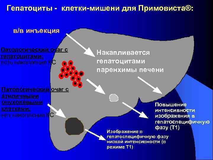 Очаги повышенной интенсивности