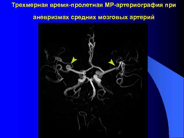 Трехмерная время-пролетная МР-артериография при аневризмах средних мозговых артерий 
