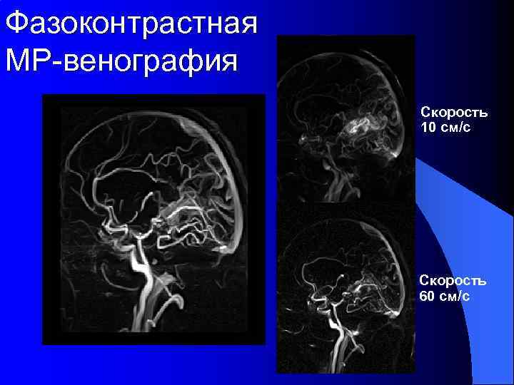 Фазоконтрастная МР-венография Скорость 10 см/с Скорость 60 см/с 
