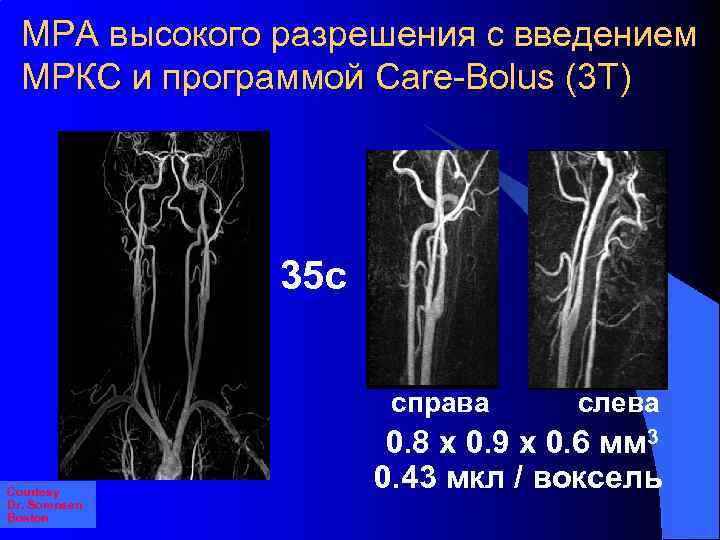МРА высокого разрешения с введением МРКС и программой Care-Bolus (3 T) 35 с справа